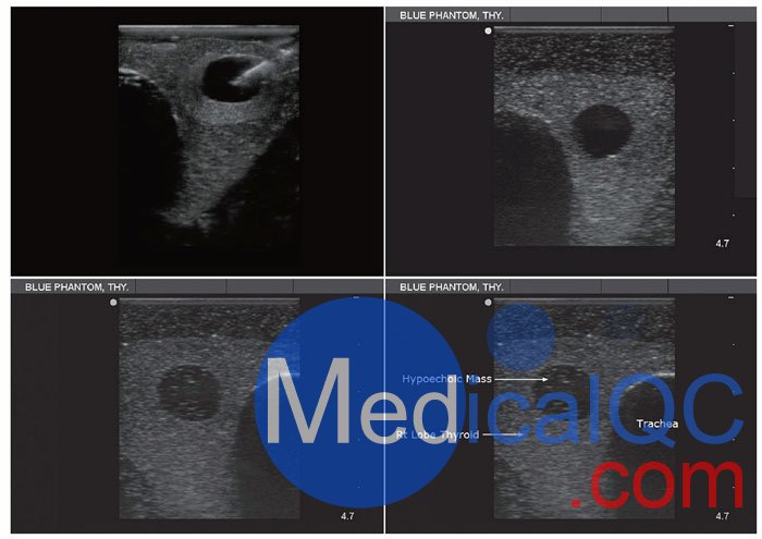 BPT195甲狀腺穿刺模型，BPT195超聲引導(dǎo)穿刺模體影像圖