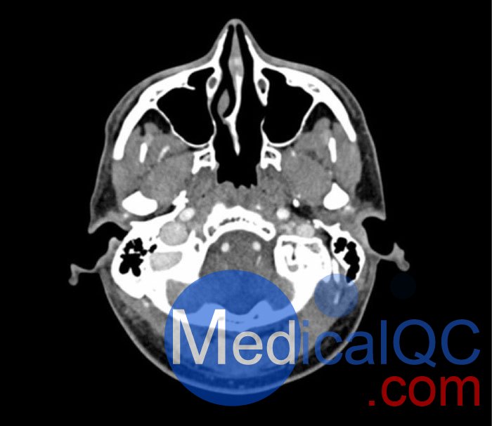 WEK50-04 CTA頭模，帶AVM CTA頭模，WEK50-04 CT血管造影頭模成像效果圖