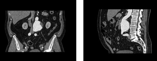 WEK53-05腹部模體，WEK53-05動脈瘤腹部模體，WEK53-05 CT血管造影模型成像