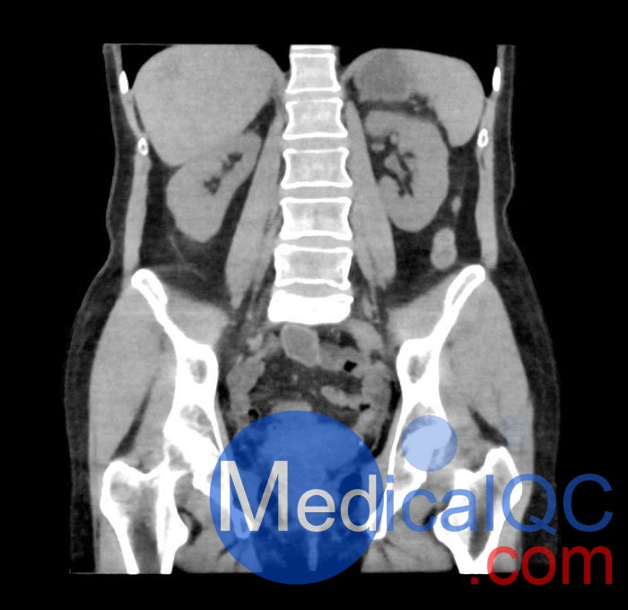 WEK55-02腹部骨盆模體，WEK55-02腹部骨盆模型成像效果圖
