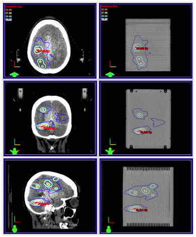 Cirs 037多病變腦QA模型，Cirs 037多病灶SRS治療計(jì)劃QA模體